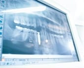 Röntgenbild - Zahnimplantat | Zahnarzt Berlin