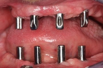 Zahnimplantate im Kiefer