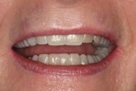 Schönes Lächeln trotz abgenutzter Zähne | Zahnarzt Berlin