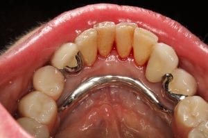 Zahnersatz: Kombiniert herausnehmbar und festsitzend | Zahnarzt Berlin