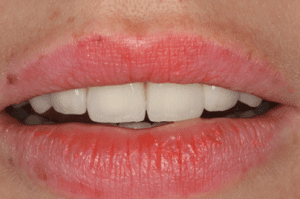 Zirkuläre Versorgung mit Vollkeramik 2 - Bisshebung Zahnarzt Berlin