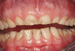 Behandlungsbeispiel 4-Quadrantensanierung - Zahnarzt Berlin